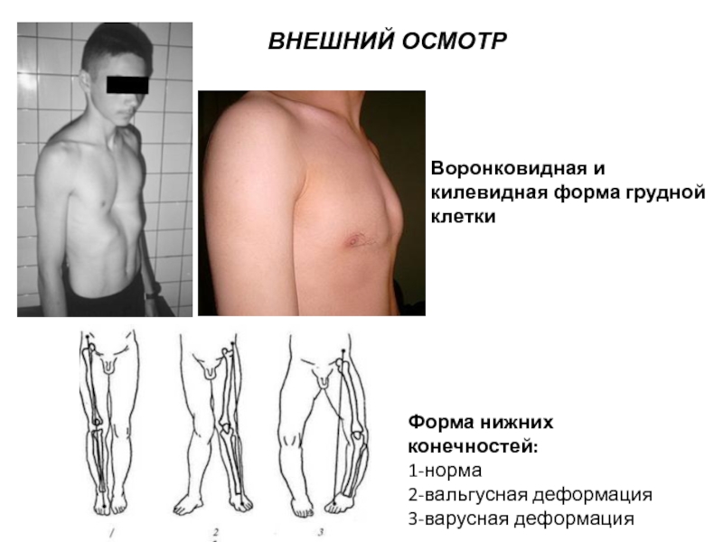 Ладьевидная грудная клетка рисунок