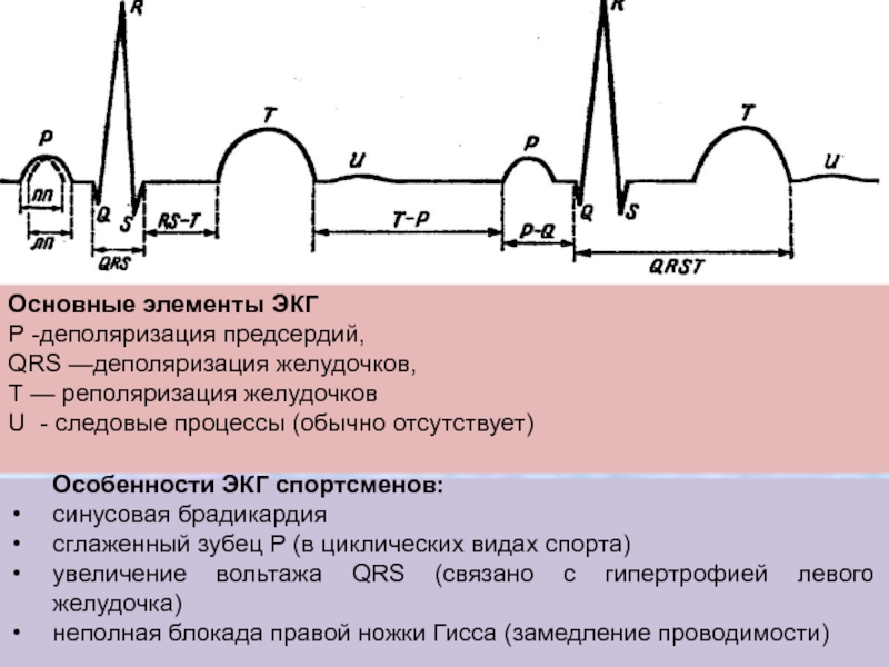 Отсутствие р на экг