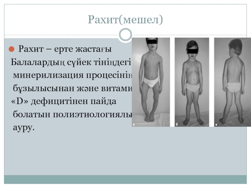 Рахит балаларда презентация