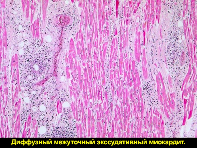 Кардиосклероз рисунок микропрепарат