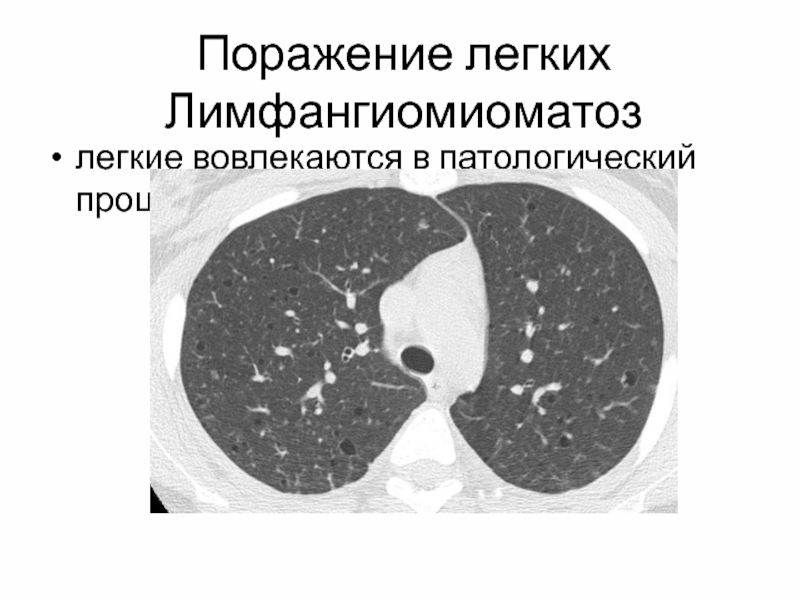 Параканкрозная пневмония на кт. Процент поражения легких. Кт степени поражения легких. 80 поражения легких