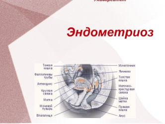 Эндометриоз. Классификация эндометриоза по локализации