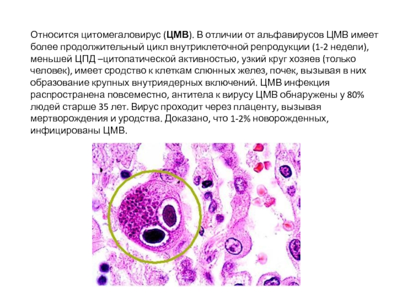 Цпд вируса это. Цитомегаловирус патогенез. Цитомегаловирус клетки Совиный глаз. Цитомегаловирусная инфекция патогенез.