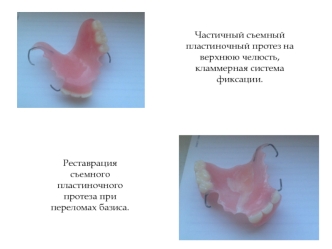 Частичный съемный пластиночный протез на верхнюю челюсть, кламмерная система фиксации