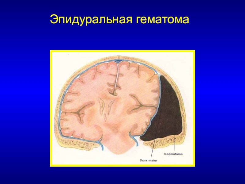 Эпидуральная гематома фото