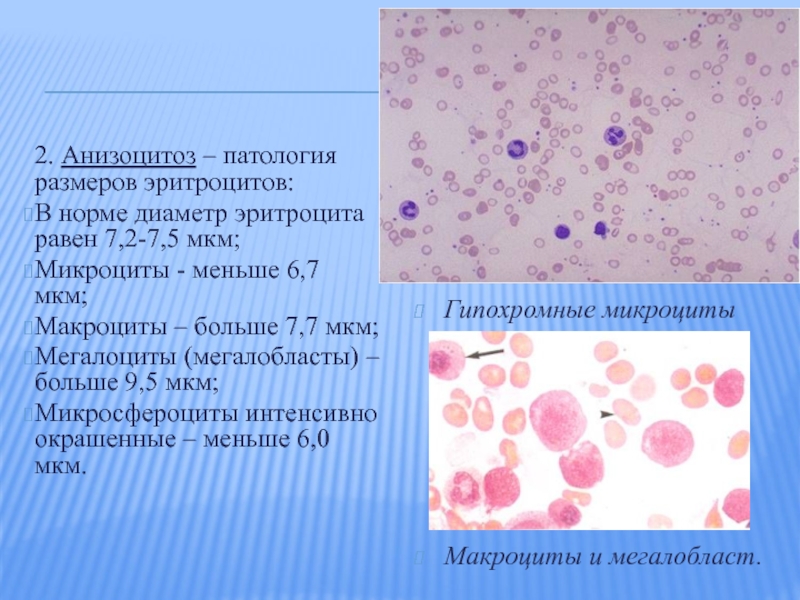 Макроциты. Макроциты и микроциты. Патологические эритроциты. Аномалии эритроцитов. Патологические изменения эритроцитов.