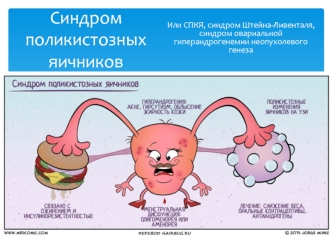 Синдром поликистозных яичников