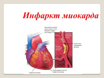 Инфаркт миокарда