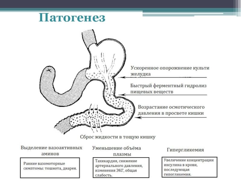 Доклад по теме Демпингсиндром