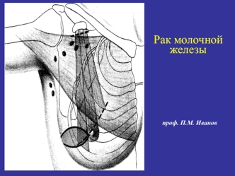 Рак молочной железы