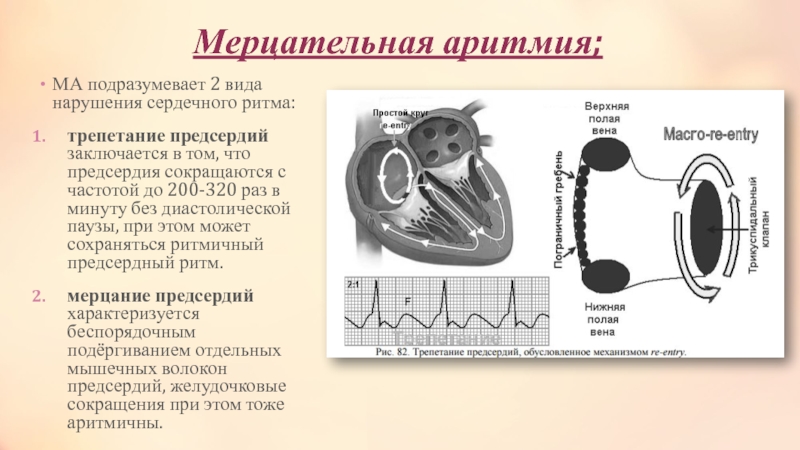 Мерцательная аритмия презентация