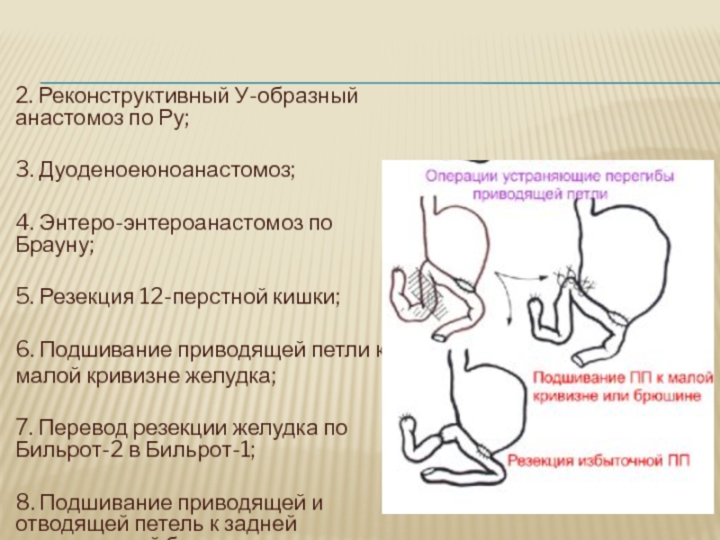 Анастомоз по ру схема