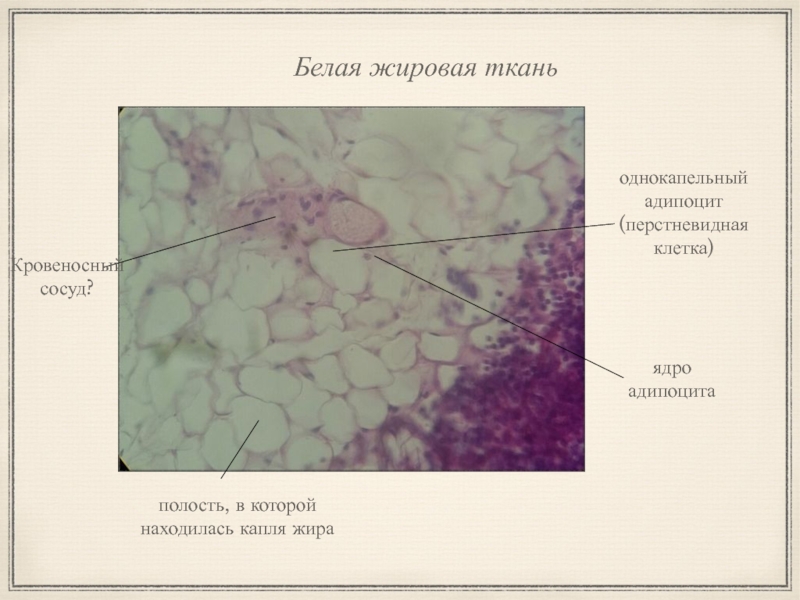 Полость в ткани. Жировая ткань ядро адипоцита. Жировая и эпителиальная ткань. Перстневидные клетки жира гистология. Бурая жировая ткань гистология.