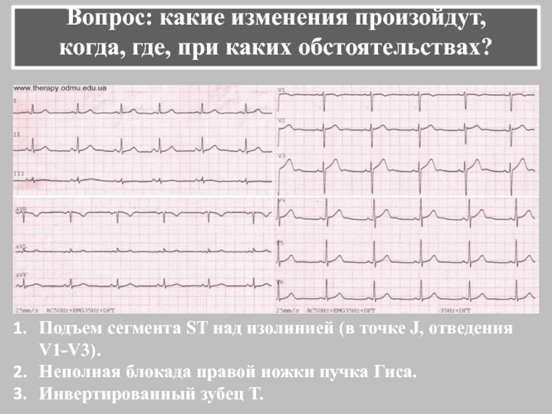 Подъем st v4. ЭКГ сегмент сегмент St. Подъём сегмента St на ЭКГ В v1-v4. Подъем сегмента St на ЭКГ v3. Подъем сегмента St на ЭКГ v1 v2.