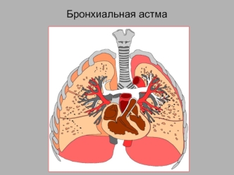 Бронхиальная астма