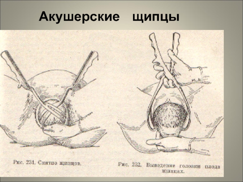 Международный день по искоренению акушерских свищей 23 мая картинки