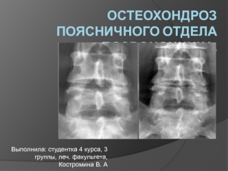 Остеохондроз поясничного отдела позвоночника