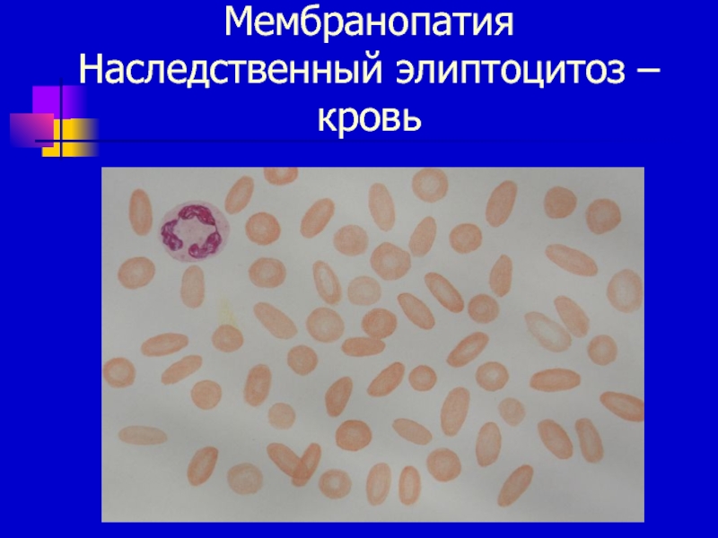 Эллиптоцитоз. Наследственные мембранопатии. Эритроцитарные мембранопатии. Мембранопатии картина крови. Мембранопатии анемии картина крови.