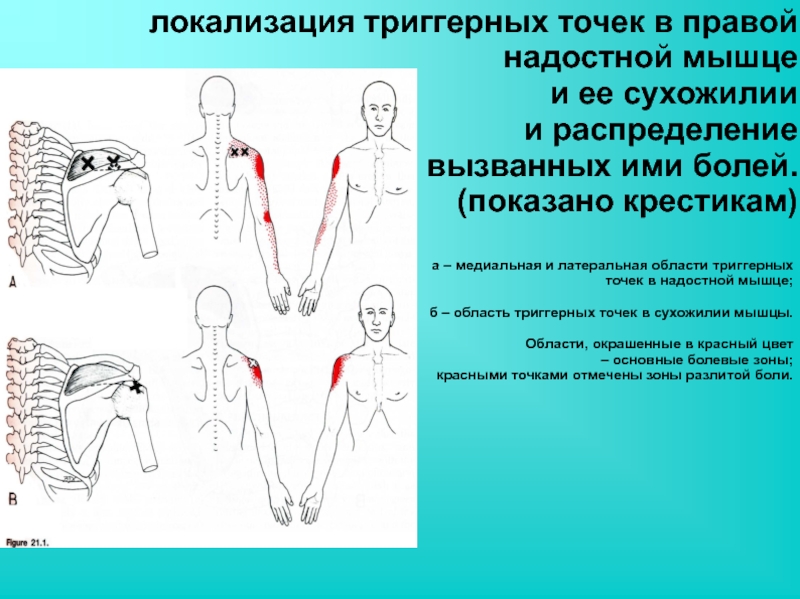 Триггерные точки это простыми словами. Надостная мышца триггерные точки. Надостная мышца локализация боли. Триггерные точки надостной мышцы плеча. Надостная мышца иррадиация боли.