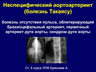 Неспецифический аортоартериит (болезнь Такаясу). Болезнь отсутствия пульса, облитерирующий брахиоцефальный и первичный артериит