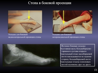 Стопа в боковой проекции