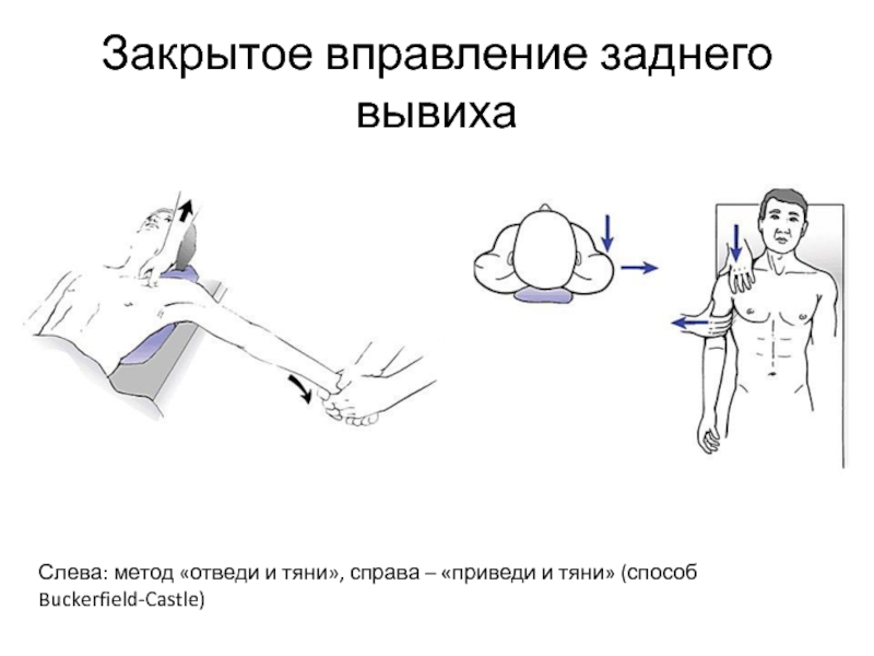 Признаки вывиха плечевого сустава