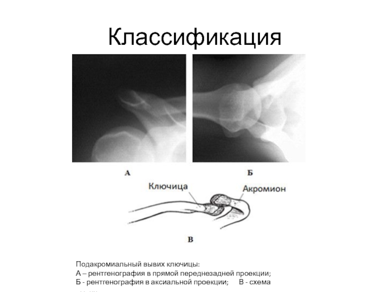 Перелом ключицы мкб 10 у взрослых