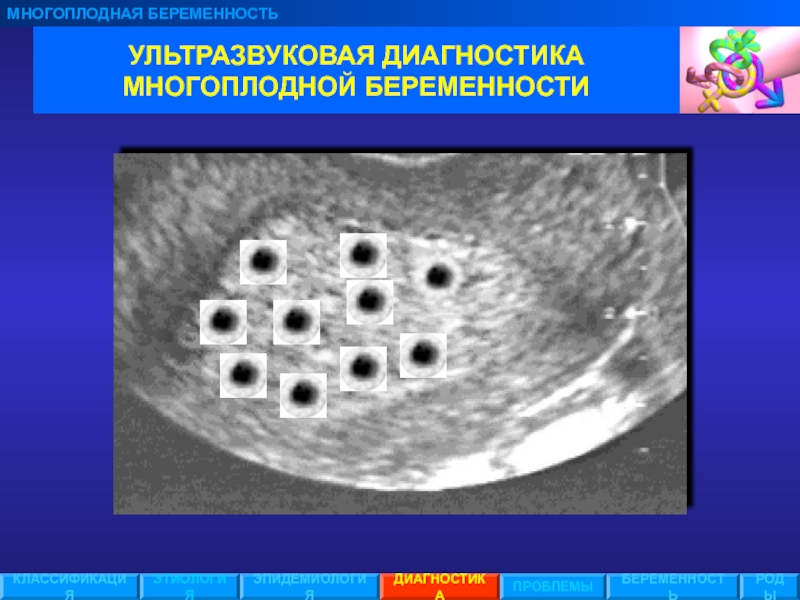 Признаки многоплодной беременности на ранних сроках. Диагностика многоплодной беременности. Диагностические признаки многоплодной беременности. Этиология многоплодной беременности. Этиология и классификация многоплодной беременности.