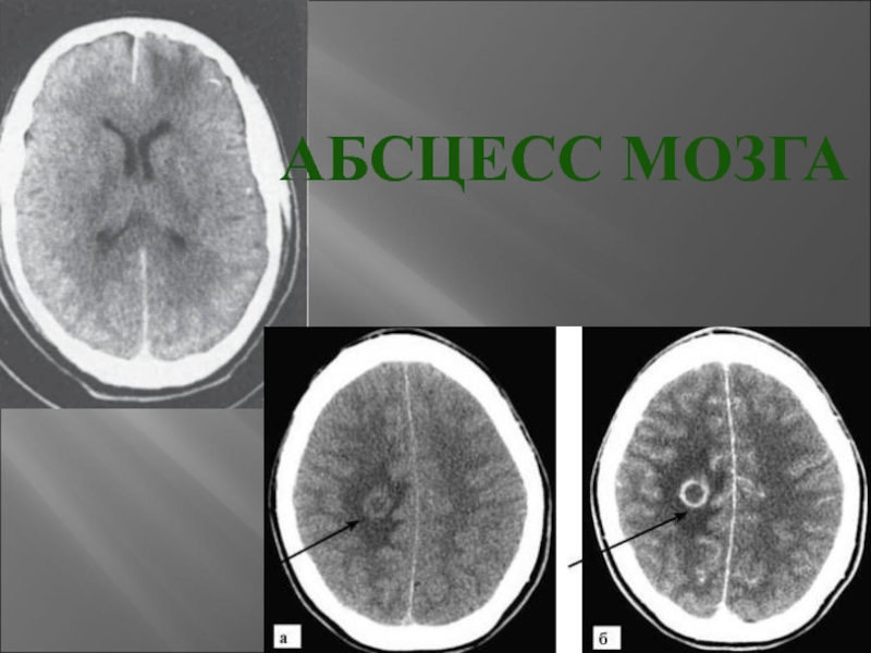 Абсцесс мозга. Абсцесса головного мозга течение. Абсцесс головного мозга мот.