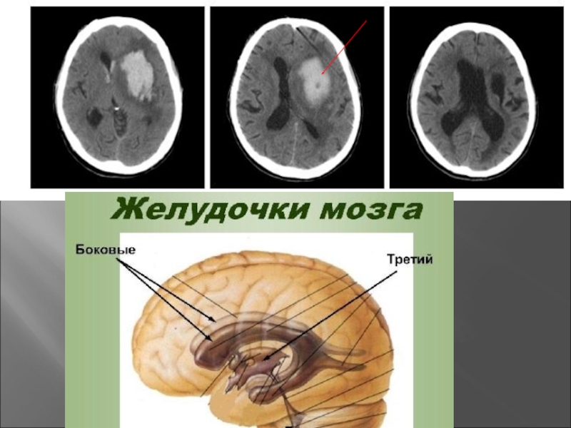 Боковые желудочки мозга. Рога желудочков мозга. Височный Рог бокового желудочка. Стенки желудочков мозга. Доли и желудочки мозга.