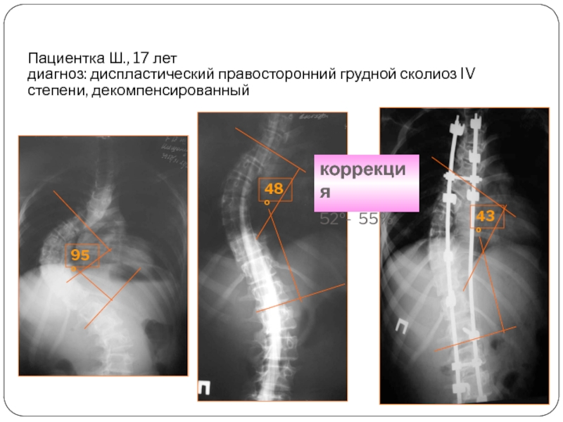 Сколиоз 4 степени инвалидность. Диспластический правосторонний грудной сколиоз. Диагноз сколиоз правосторонний. Диспластический правосторонний грудной сколиоз 1 степени.