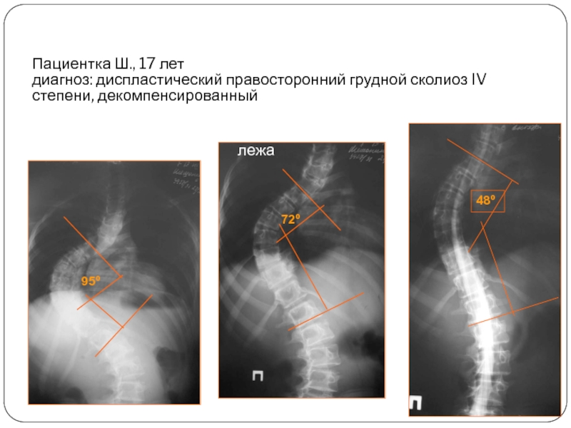 Диагноз правосторонний. Степени сколиоза по чаклину 4 степень рентген. Диспластический сколиоз рентген степени. Сколиоза по чаклину рентген. 3 Степень сколиоза по чаклину рентген.