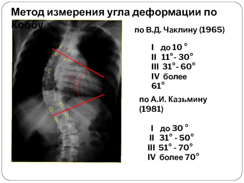 Угол кобба. Угол Кобба степени сколиоза. Сколиотическая деформация по чаклину. Степени искривления позвоночника по коббу. Метод измерения угла деформации по коббу.