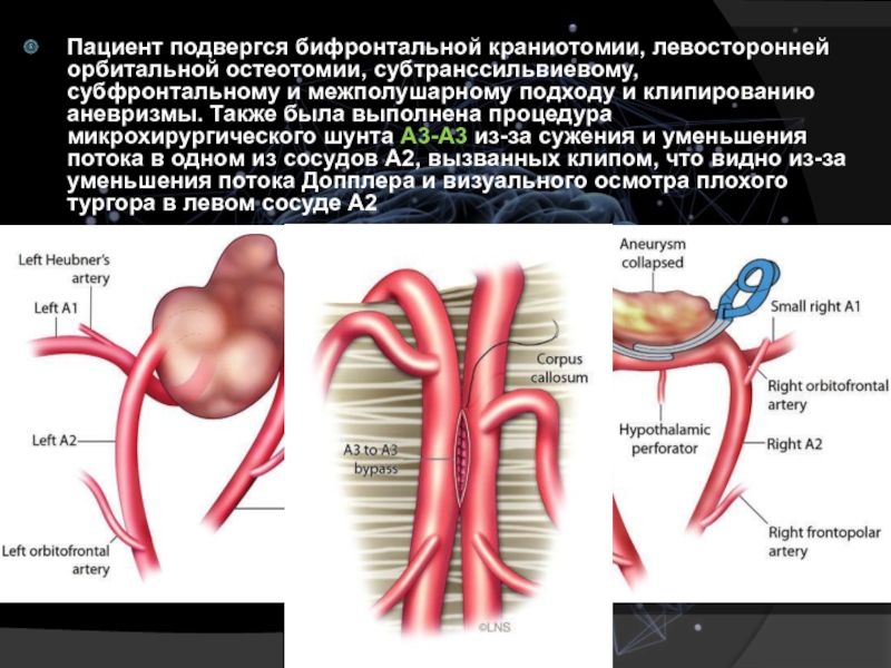 Аневризма сосудов. Аневризма головного мозга клипирование. Микрохирургическое клипирование аневризмы. Клипирование шейки аневризмы.