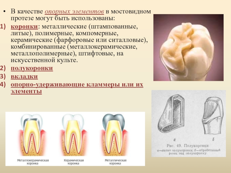 Металлические коронки презентация