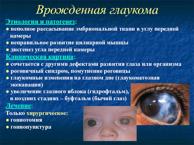 Один из супругов страдает глаукомой. Врожденная глаукома этиология. Врожденная глаукома буфтальм. Первичная врожденная глаукома.