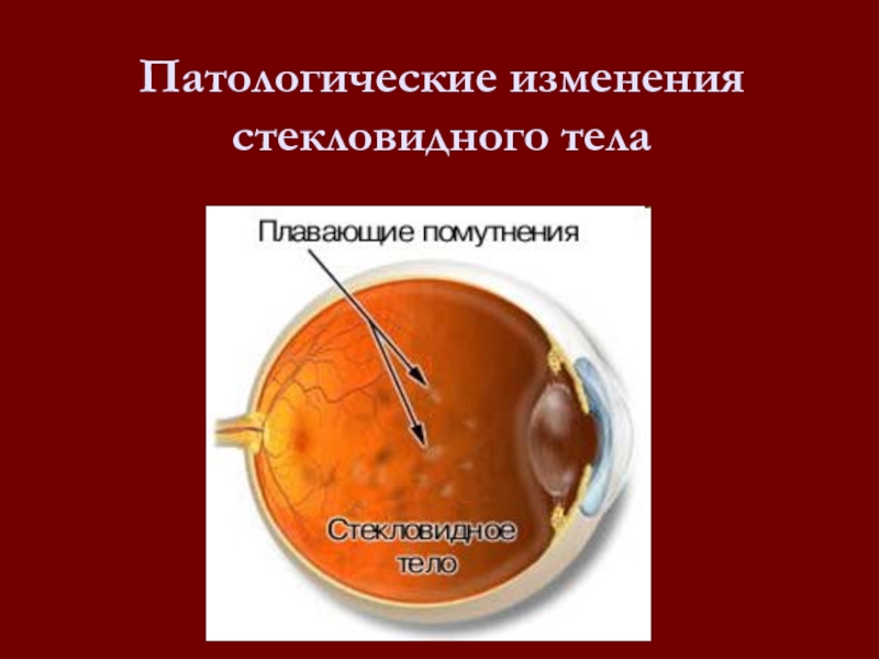 Помутнение стекловидного тела. Инъекция в стекловидное тело. Инъекции в стекловидное тело глаза. Патологические изменения. Стекловидное тело возрастные особенности.