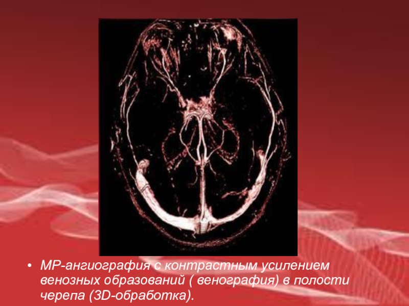 Контрастная ангиография. Показания к ангиографии. Бесконтрастная МР ангиография. Лучевая диагностика в неврологии.