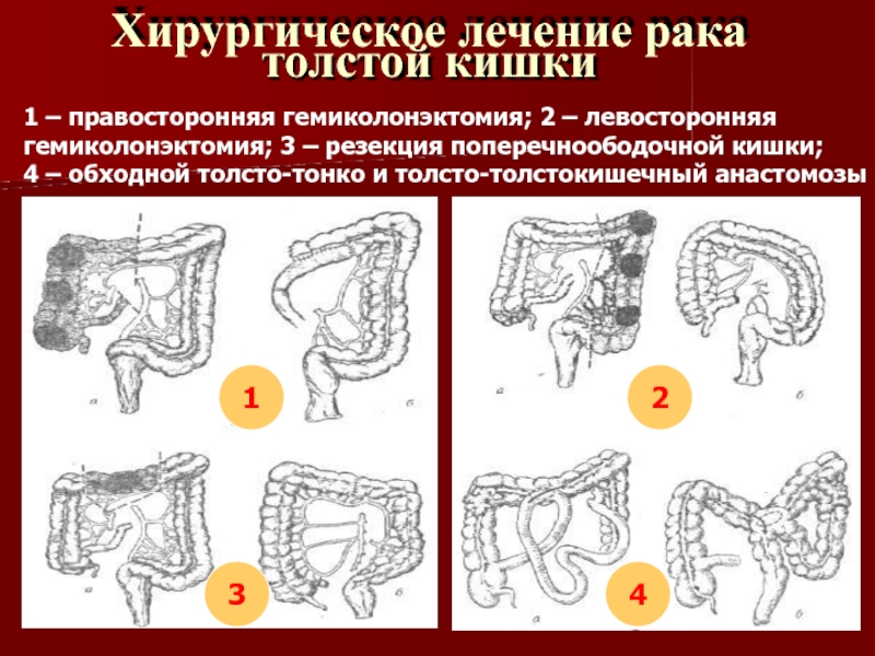 Ректоцеле прямой кишки фото