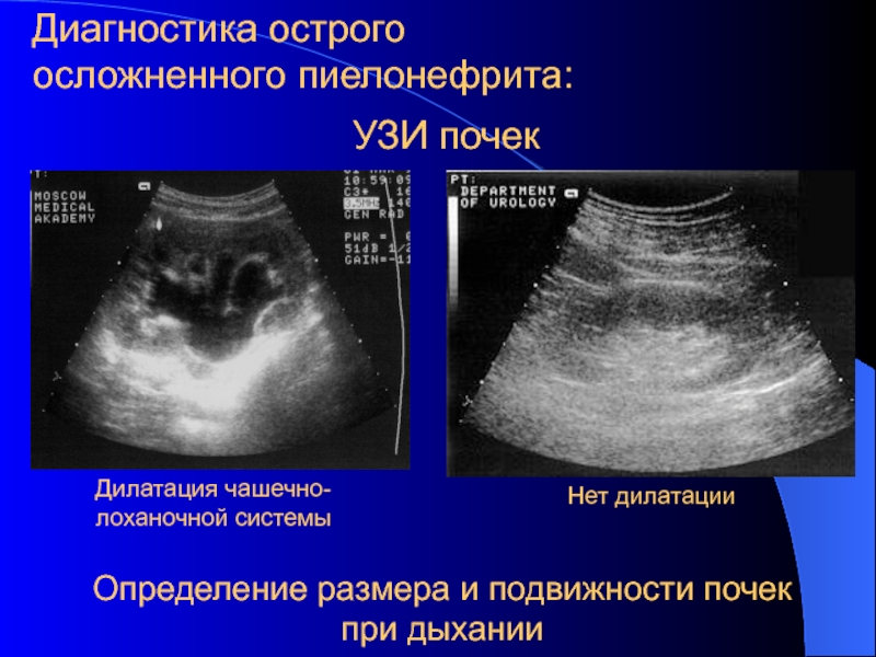 Гломерулонефрит на узи фото