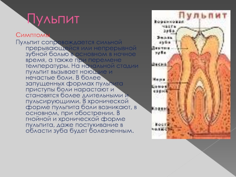 Этиология патогенез пульпита презентация