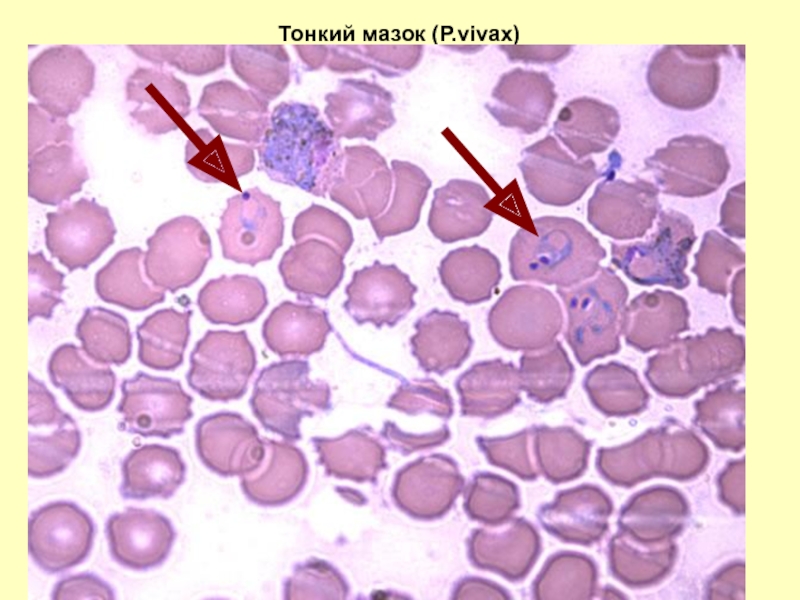 Фото мазков на малярию