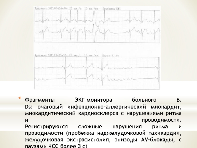 Наджелудочковая тахикардия карта вызова смп