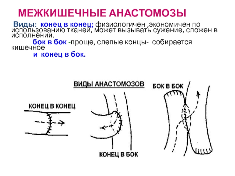 Анастомоз конец в конец схема