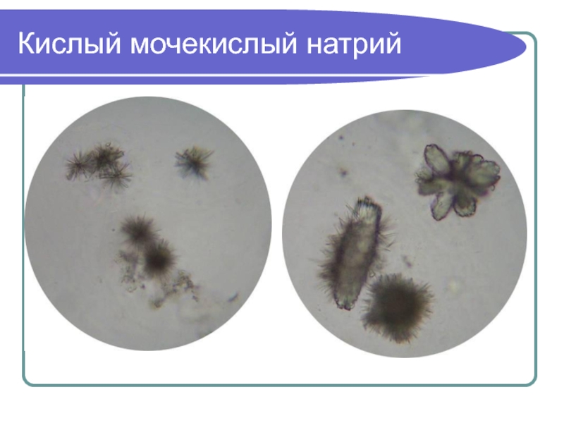 Мочекислый аммоний в моче фото под микроскопом