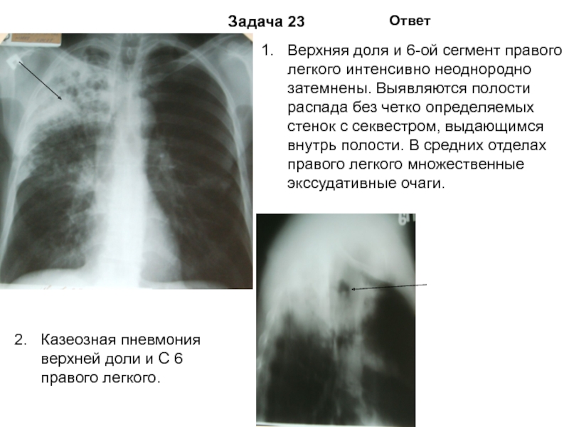 Реферат: Туберкулема правого легкого