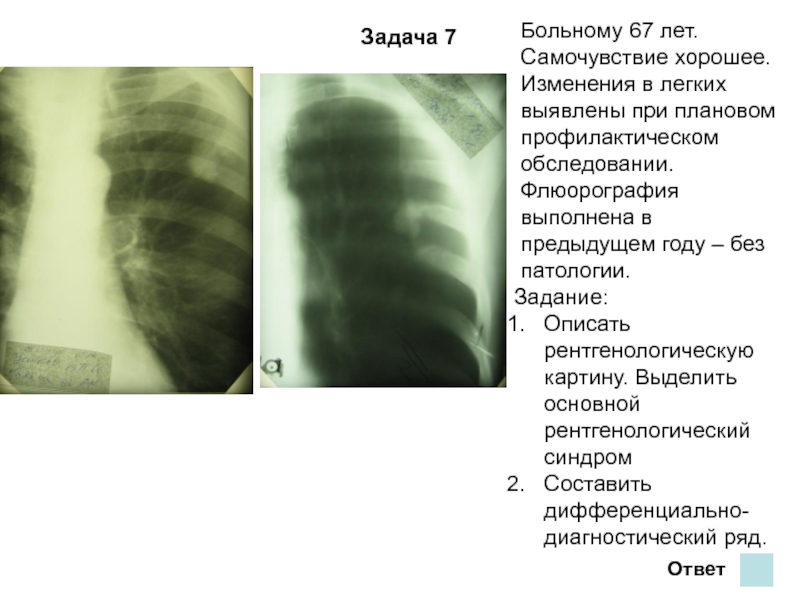 Изменение легочного рисунка на флюорографии что это значит