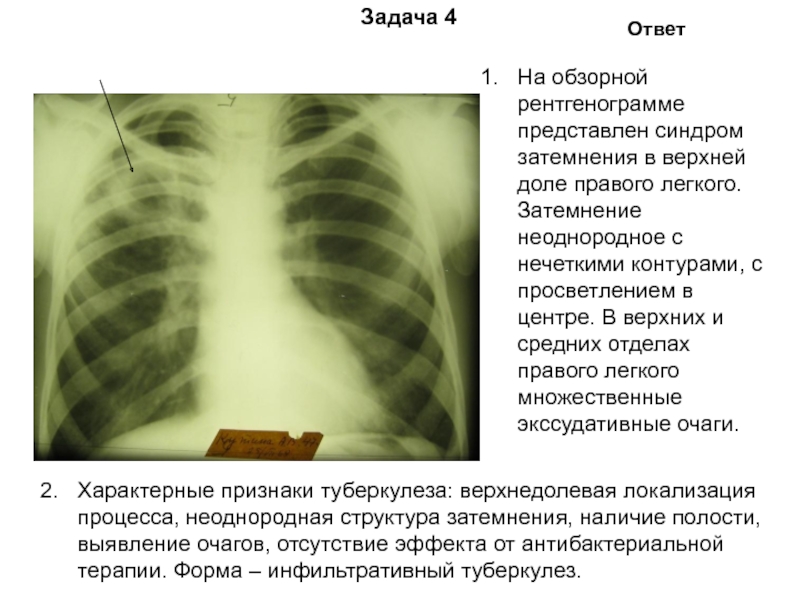 Усиление легочного рисунка флюорография