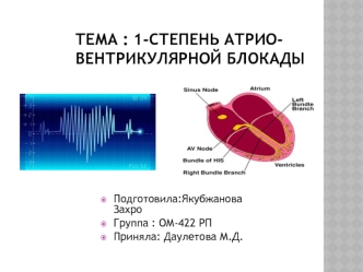 Первая степень атрио-вентрикулярной блокады