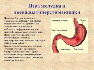 Язва желудка и двенадцатиперстной кишки